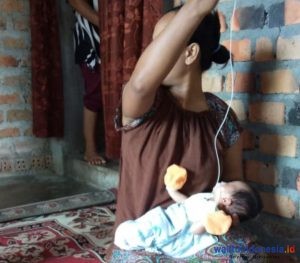 Balita Penderita Bibir Sumbing Bardatu Butuh Uluran Tangan